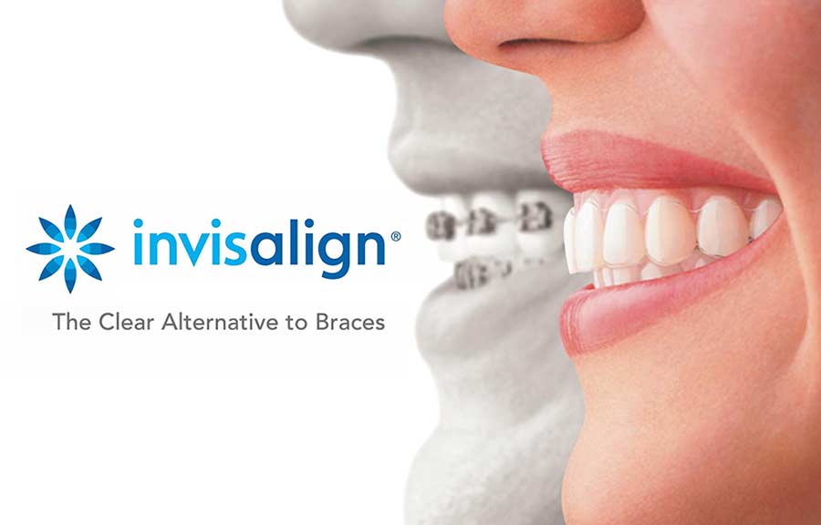 Invisalign promotion at RTC Dental in Reston, VA for Dentist Reston VA services.