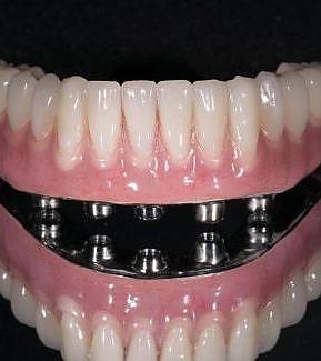 view of dentures at RTC Dental in Arlington for Teeth whitening Reston services.