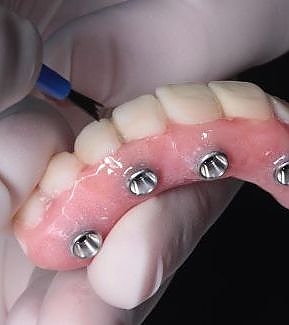 view of dentures at RTC Dental in McLean for Invisalign Reston services.