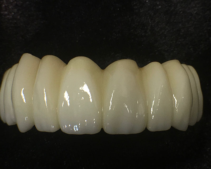 view of dentures at RTC Dental in Reston, VA for Dentist Reston VA services.