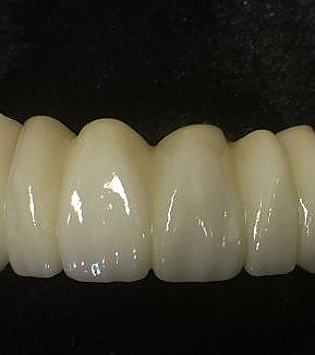 view of dentures at RTC Dental in Reston, VA for Dentist Reston VA services.