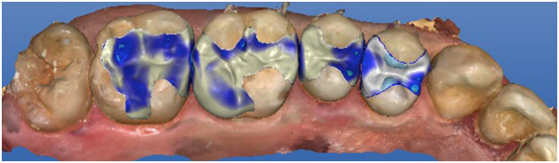 close up of teeth at RTC Dental in Sterling for Cosmetic dentist Reston services.