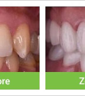 Zoom Teeth Whitening